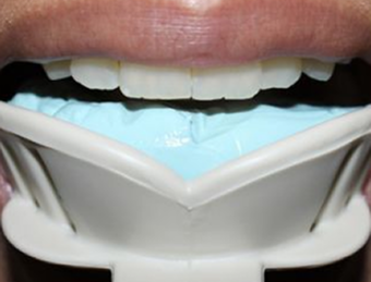 take home whitening