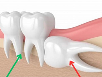 wisdom teeth extraction complex cases and impacted